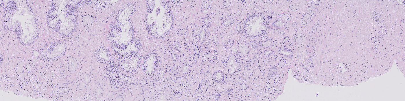 Prostate Cancer Detection, AI