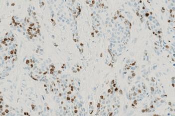 IHC, Tumor Detection, AI