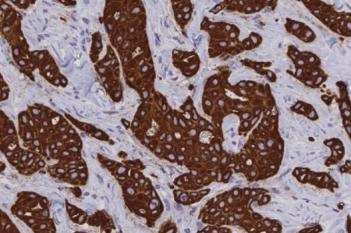 PCK VDS, Tumor Detection