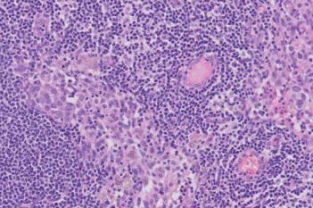 Metastasis Detection, AI