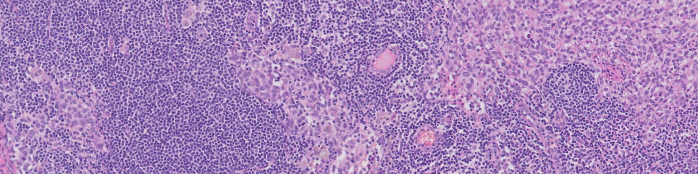 Metastasis Detection, AI