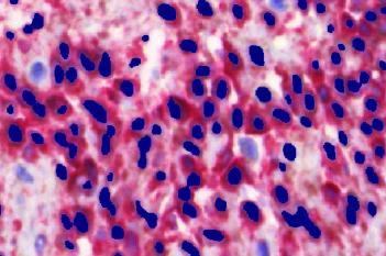 Ki-67+MART1, Melanoma