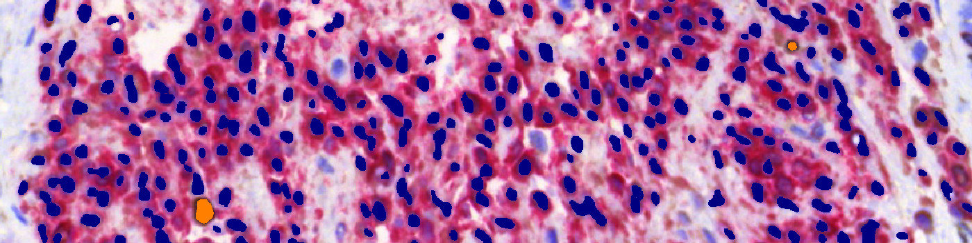 Ki-67+MART1, Melanoma