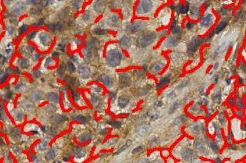 NBCN1, Breast Cancer