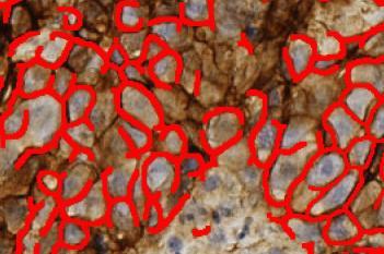 Glut1, Breast/Colon/Lung Cancer