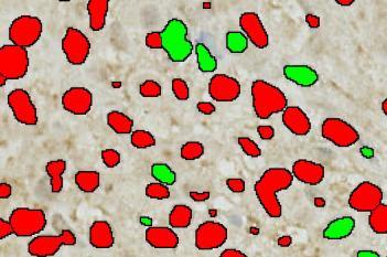 Survivin, Bladder Cancer