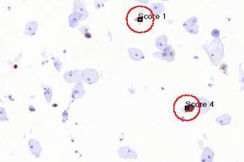 p16+Ki-67, Cervical Cancer, ICC