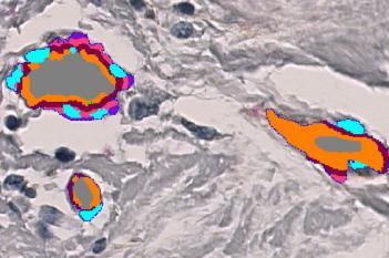 aSMA+Col IV, Breast Cancer