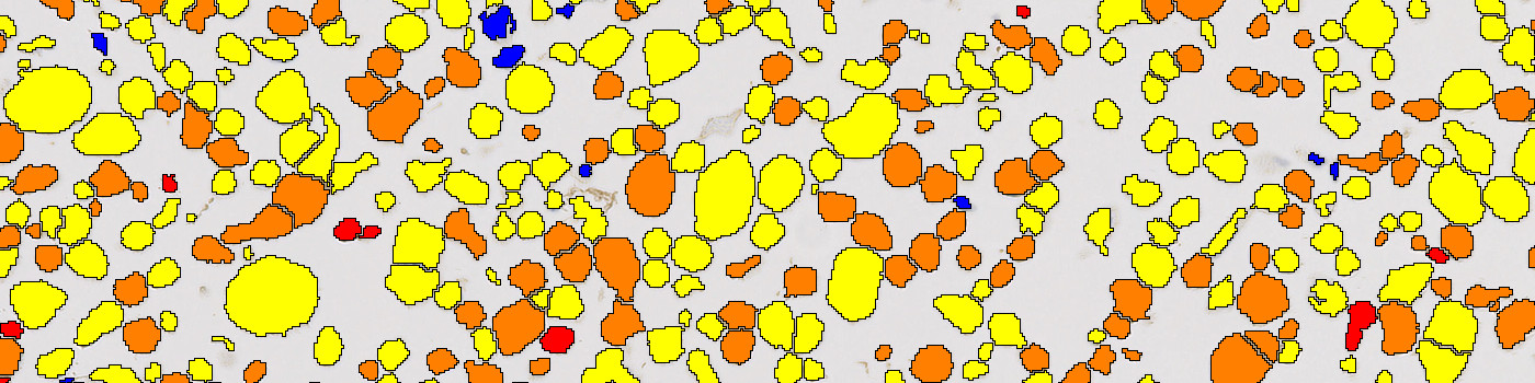 ALK, Cell Lines, Cancer