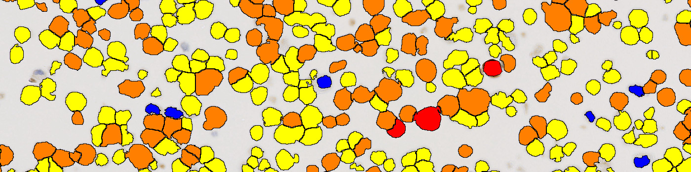ROS1, Cell Lines, Cancer