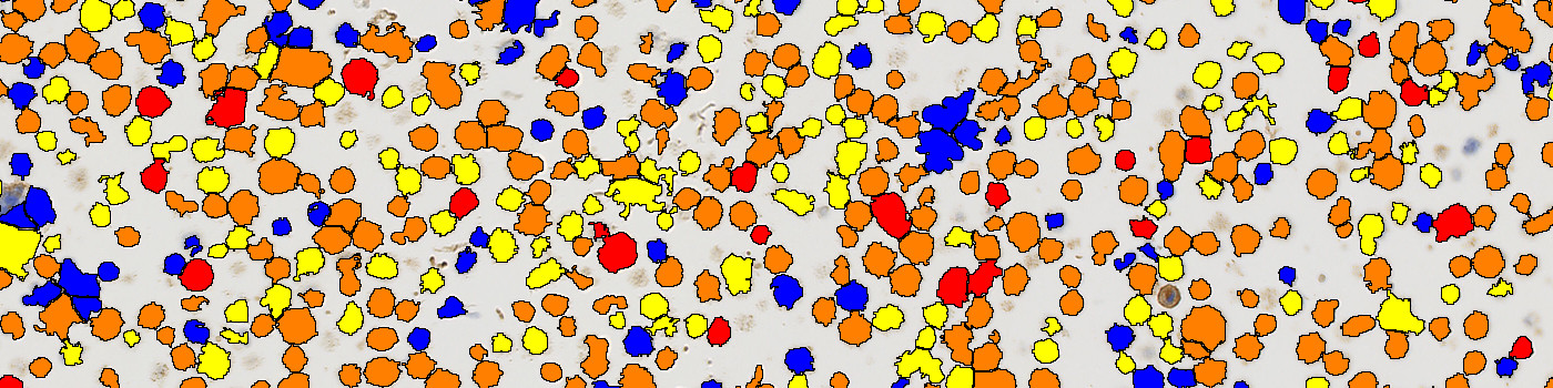 MET, Cell Lines, Cancer