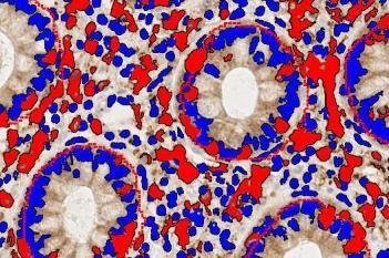 CD3, Lymphocytic Colitis