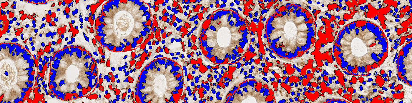 CD3, Lymphocytic Colitis