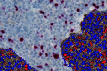 CK5+Ki-67, Neck Cancer