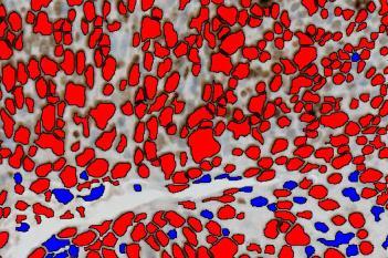 Ki-67 + CK5 VDS, Neck Cancer