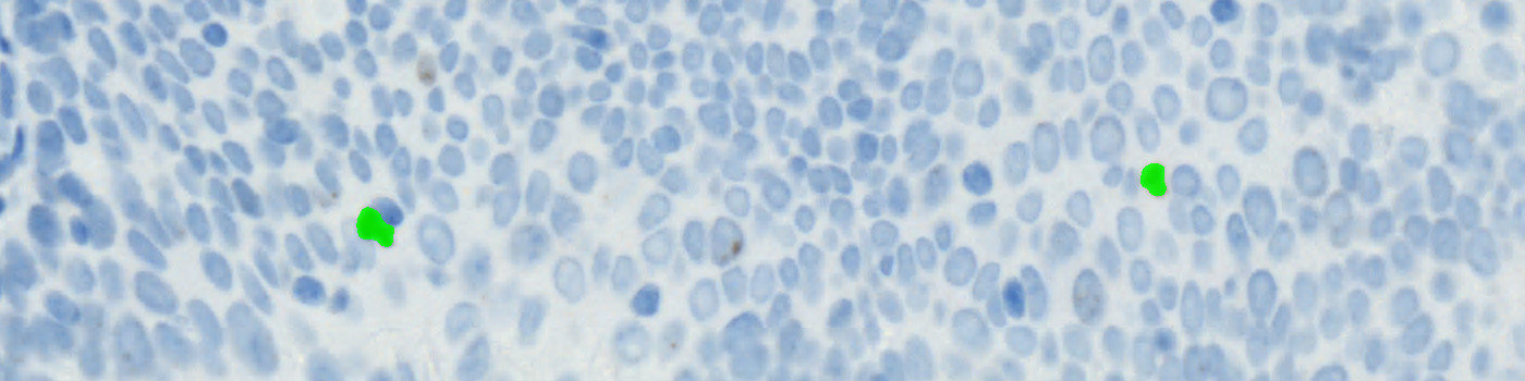 PHH3 + CK5 VDS, Neck Cancer