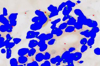 RNAscope, Skin Cancer