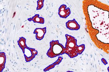 Invasive Tumor Detection (PDS)