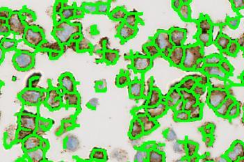 HER2, Cell Lines, Cancer