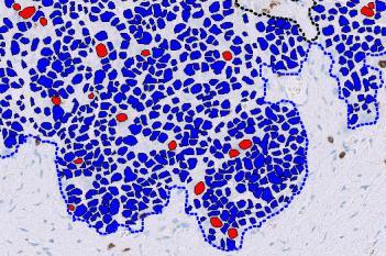 CD8, Ovarian Cancer, TME