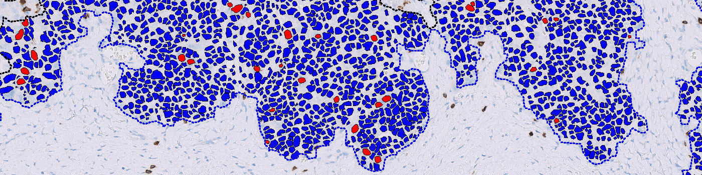 CD8, Ovarian Cancer, TME