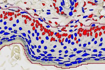 Ki-67, Epidermal Hyperplasia