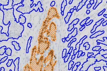 Invasive Tumor Detection (VDS)