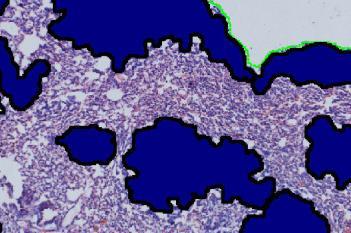 H&E, Lung Metastasis