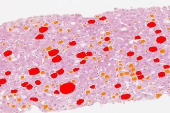 H&E, Liver Steatosis