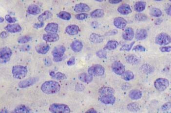 RNAscope, Hepatocellular Carcinoma