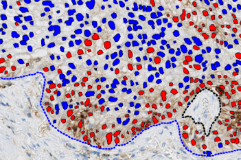 PD-L1, Melanoma, TME