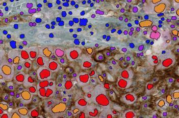 PD-L1+SOX10, Melanoma, TME