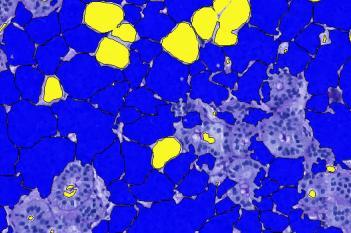 PAS + PCK (VDS), Salivary Gland Tumor