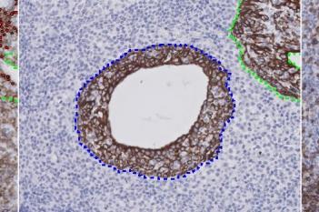 CD3+CD20+CK, Sjögren's Syndrome