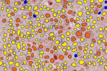 m-PGES1, Melanoma, TME