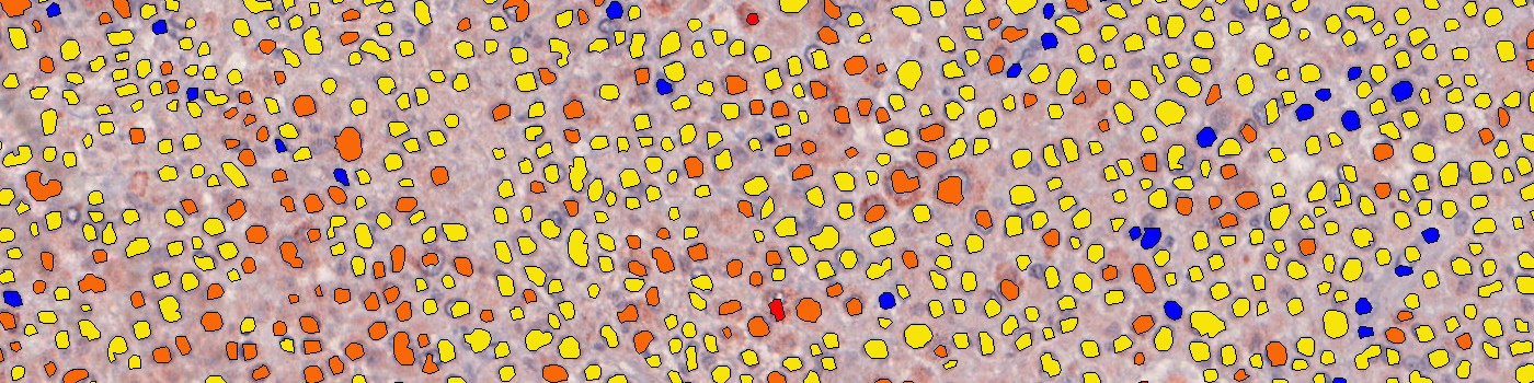 m-PGES1, Melanoma, TME