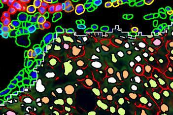 Virtual 8-plex Multiplexing, Breast Cancer, TME