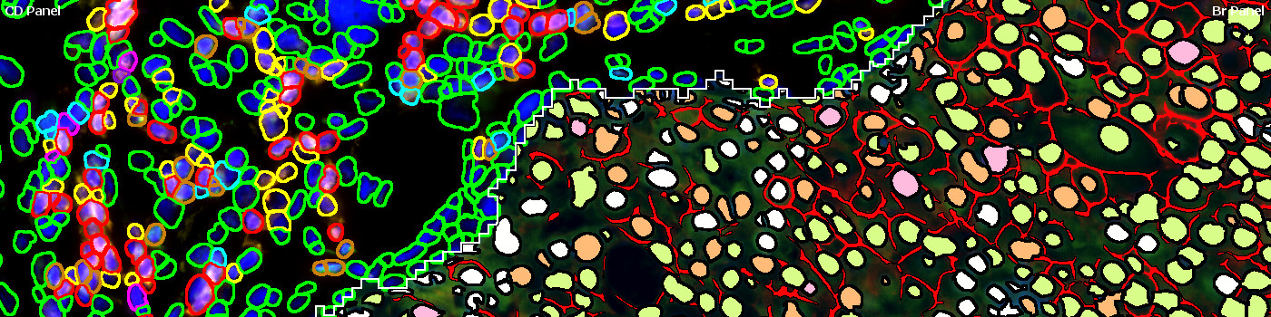 Virtual 8-plex Multiplexing, Breast Cancer, TME