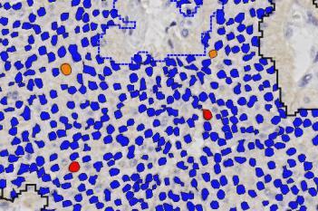 Ki-67, Neuroendocrine Neoplasm
