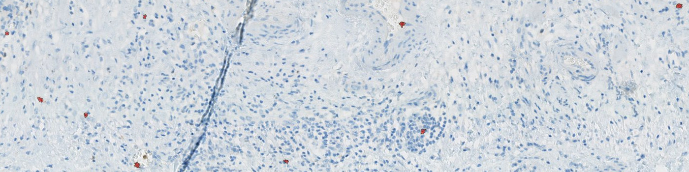 CD57, Ovarian Cancer, TME