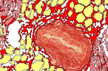 Picrosirius Red, SADS