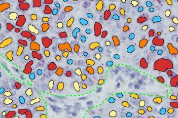 PD-L1 RISH, Lung cancer, TME