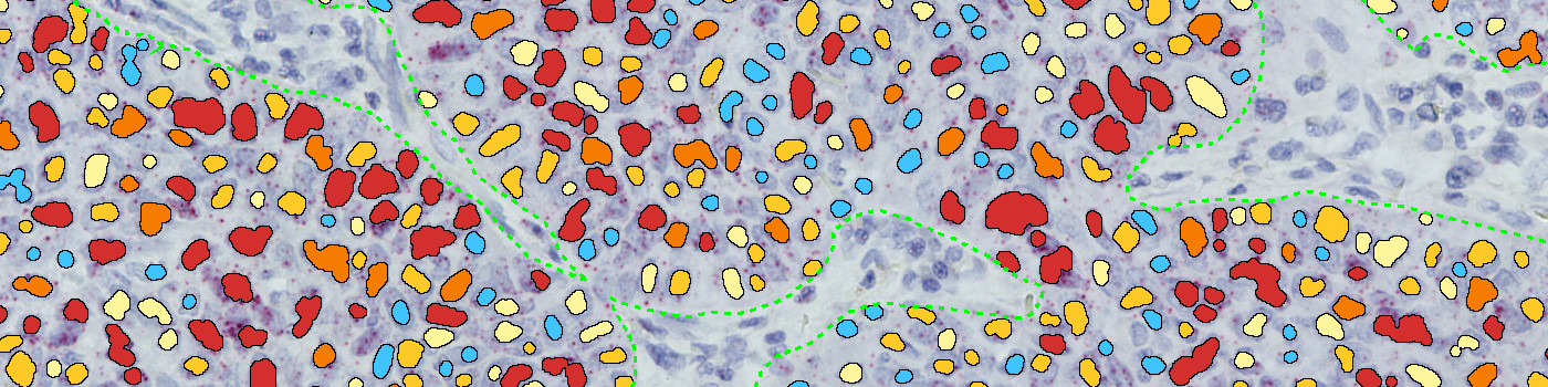 PD-L1 RISH, Lung cancer, TME