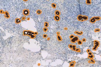 CK, Metastasis Detection