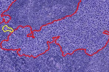 Metastasis Detection, AI