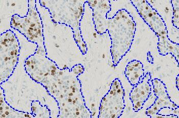 IHC, Tumor Detection, AI