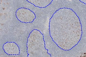 PD-L1, Germinal Center Detection, AI