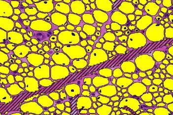 H&E, Centronuclear Myopathy