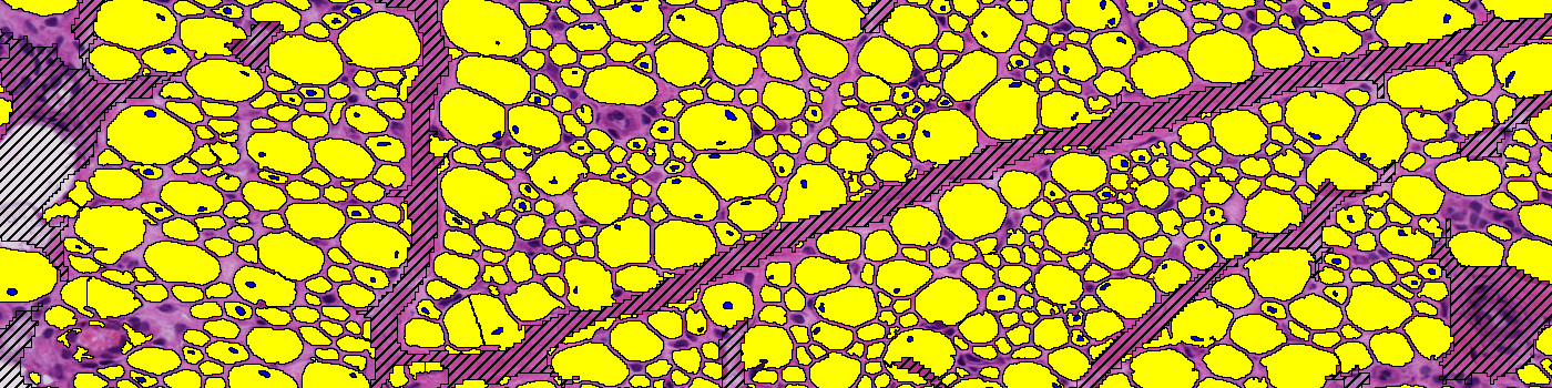 H&E, Centronuclear Myopathy