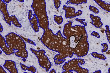 PCK VDS, Tumor Detection